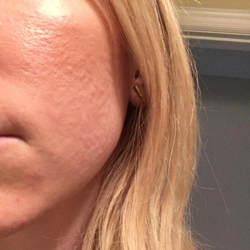 3. Your Skin Is Oily, Dull, And Always Breaking Out, Even when you're eating clean and doing everything right